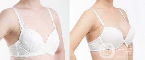 復(fù)合隆胸多久可以上班 術(shù)后注意事項(xiàng)有哪些