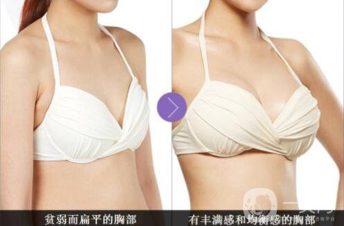 自體脂肪隆胸多久不疼？ 脂肪隆胸的害處？