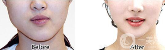 什么是* *手術(shù)的特點(diǎn)有哪些