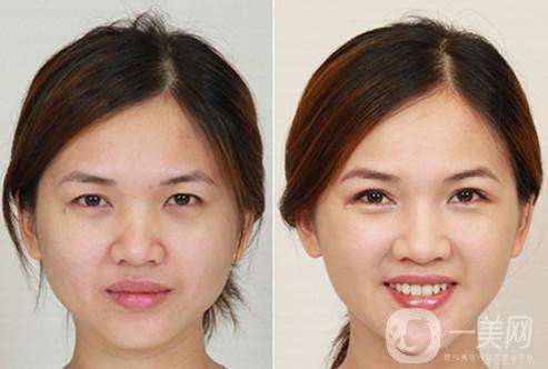 韓國自然*是什么 哪些人適合做韓國自然*