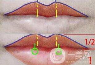 厚唇改薄手術(shù)注意事項(xiàng)