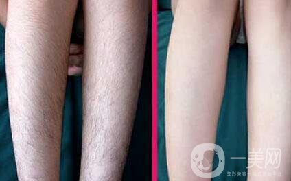 全身光子脫毛價(jià)格