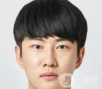 男人隆鼻前后附照片 隆鼻*果好嗎？