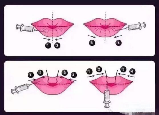 玻尿酸豐唇有什么危害呢 玻尿酸豐唇怎么樣？