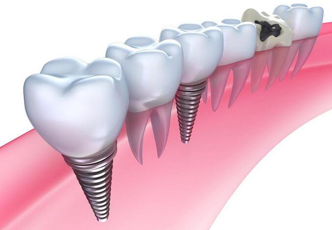 種植牙多少錢一顆 價格高不高？