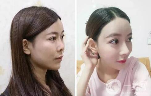 什么是朝天鼻？朝天鼻怎么矯正？