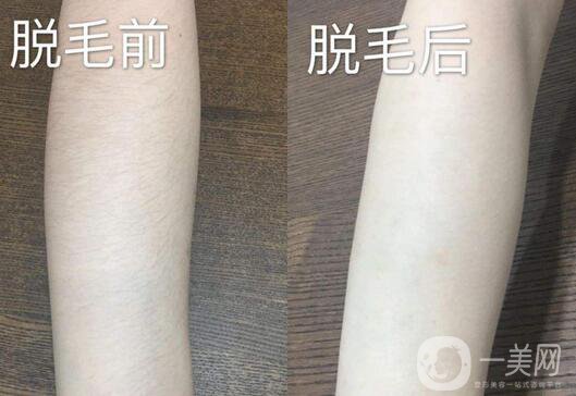 激光脫毛詳細介紹 激光脫毛有哪些優(yōu)缺點？