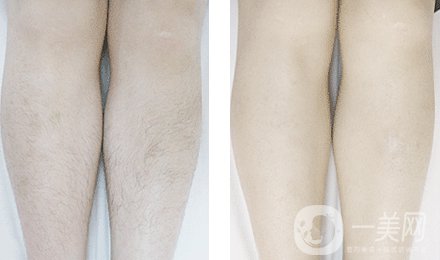 彩光脫毛價(jià)格 彩光脫毛的具體費(fèi)用 