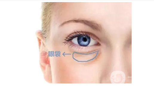 去眼袋手術(shù)費(fèi)用是多少錢(qián) *果*嗎