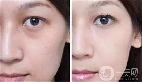 去眼袋手術(shù)費(fèi)用是多少錢(qián) *果*嗎