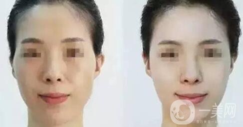 顴骨手術(shù)是指什么 哪些人適合做顴骨手術(shù)