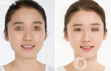 　　什么是短下巴手術(shù)?如果前下巴下陷，就用手術(shù)切下巴，把下巴向前移動(dòng)。這種定制的手術(shù)使下巴向前移動(dòng)，通過諸如前進(jìn)、T截骨和假體插入等步驟，使面部線條自然而美觀，這取決于個(gè)人的下巴狀況。短下巴手術(shù)，以移動(dòng)下巴尖向前，糾正不明確的下巴線，并改良你的臉，如果你的牙齒遮擋是好的，盡管你的下陷下巴。  什么是短下巴手術(shù) 短下巴手術(shù)類型  　　短下巴手術(shù)認(rèn)為是一個(gè)短下巴(微頜)，如果下巴是下陷，牙合是差的。它可以通過雙頜截骨術(shù)(雙頜手術(shù))矯正，使整個(gè)下巴向前移動(dòng)。  　　雙頜截骨術(shù)(雙頜手術(shù))的捷徑骨刀提高準(zhǔn)確性，骨手術(shù)刀是一種超聲波裝置，它只對(duì)骨組織起反應(yīng)作用，從而切割骨骼。它有較小的振動(dòng)在0.5mm內(nèi)，使一個(gè)**的手術(shù)，保護(hù)附近的血管和神經(jīng)，只對(duì)骨骼作出反應(yīng)，造成較少的組織損傷和出血，并提供*。    　　這些人需要做短下巴手術(shù)：  　　1、如果你的下顎凹陷了  　　2、如果你的下顎很小  　　3、如果你有突出的上牙  　　4、如果你的下巴和脖子有一個(gè)不清楚的界限  　　5、如果你看起來像下巴上有很多脂肪，下巴很短，就會(huì)有皺紋。  　　6、如果你經(jīng)常聽到你看起來很遲鈍  　　短下巴手術(shù)類型  　　1、前下巴(下巴尖)前進(jìn)。這個(gè)過程把下陷的骨頭切成向前移動(dòng)的長度。根據(jù)骨切除的角度調(diào)整下巴的長度，形成一條自然的下頜線。  　　2、把下陷的骨頭往前移。這一過程減少和糾正了下巴的寬度，使下巴線條更苗條、更漂亮。  　　3、集骨。收集切割的骨頭并向前移動(dòng)。  　　4、刮去骨頭。平滑地研磨下巴線。  　　5、假體插入。這個(gè)過程通過口腔的一個(gè)小切口將塑造成下巴骨輪廓的假體插入到下巴骨的前側(cè)。