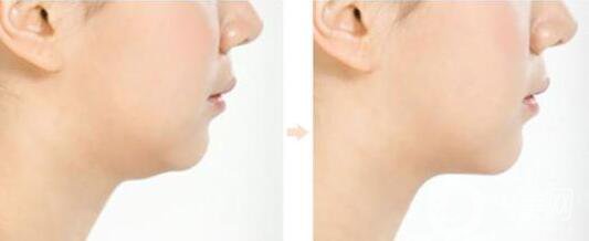 什么是短下巴手術(shù) 短下巴手術(shù)類型