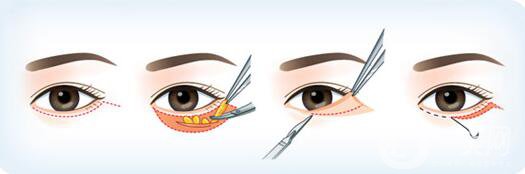 韓式去眼袋怎么樣？多久*果