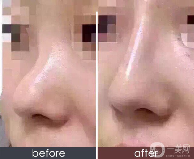 耳軟骨硅膠隆鼻*嗎 