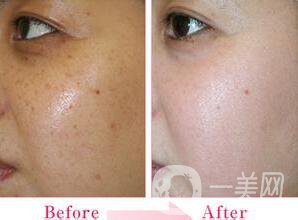 黃褐斑,老年斑,雀斑