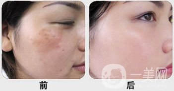 白瓷娃娃做完多久*果？幾次*果？