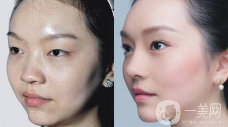 整容的后遺癥有哪些 后遺癥會(huì)消失嗎