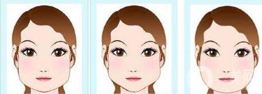 磨骨手術需要多少錢 調(diào)節(jié)費用是多少