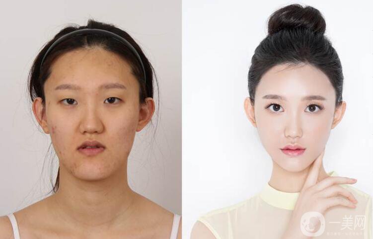 什么是納米雙頜截骨術(shù) 納米雙頜截骨術(shù)的特點