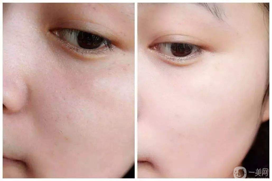 水光嫩膚一般一次多少錢