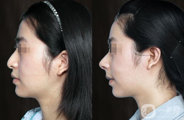 耳軟骨鼻尖多久會吸收 多久變自然呢？