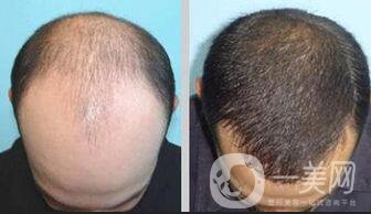 男性,頭發(fā)種植術(shù),多少錢