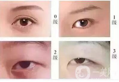 開(kāi)內(nèi)外眼角的區(qū)別,開(kāi)內(nèi)眼角,開(kāi)外眼角