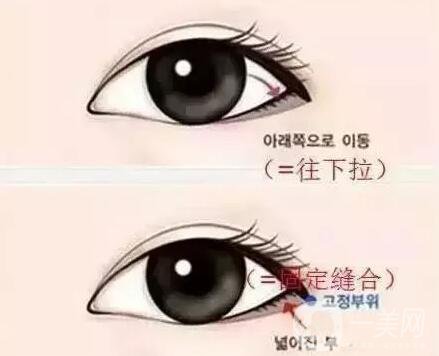 開(kāi)內(nèi)外眼角的區(qū)別,開(kāi)內(nèi)眼角,開(kāi)外眼角