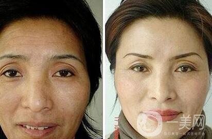 拉皮手術(shù)照片,拉皮手術(shù)后遺癥