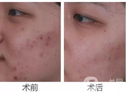 微針多少錢一次,微針作用維持多久