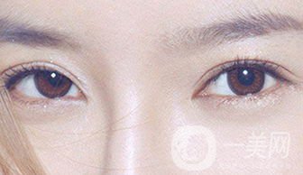 怎么開眼角 開眼角有什么危害嗎？