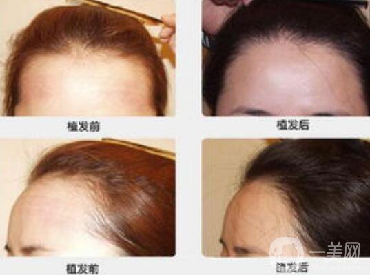 植發(fā)危害,植發(fā)優(yōu)點,植發(fā)價格