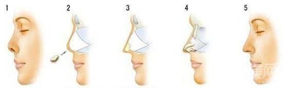 自體肋軟骨隆鼻后遺癥有些啥？