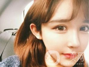 割雙眼皮多久恢復(fù)自然？