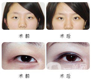 割雙眼皮多久恢復(fù)自然？