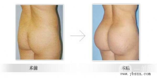 豐臀可以打玻尿酸嗎？*果如何？