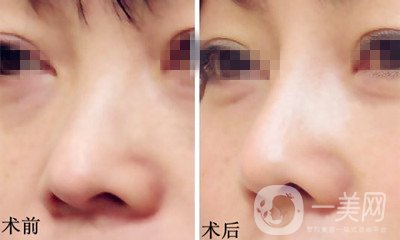 膨體隆鼻是終生的嗎？