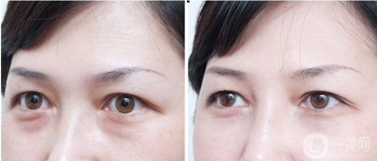 超聲波去眼袋多少錢 超聲波去眼袋價(jià)格