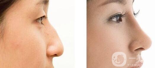 自體隆鼻后遺癥有哪些呢