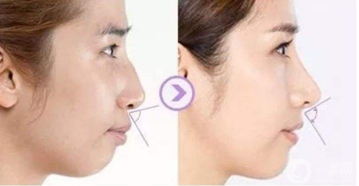 突嘴矯正的方法有哪些