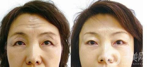 激光去抬頭紋多少錢 激光去抬頭紋有副作用嗎