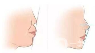 臉型矯正手術(shù)多少錢