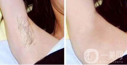 *激光脫毛多少錢,*激光脫腋毛費(fèi)用