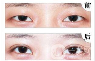 上眼皮吸脂價(jià)格,雙眼皮