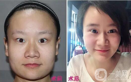 上眼皮吸脂價(jià)格,雙眼皮