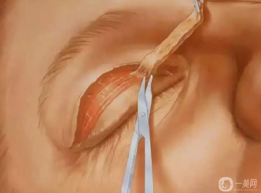 上眼皮吸脂價(jià)格,雙眼皮