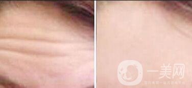 去除抬頭紋風險,去除抬頭紋方法