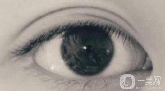 開眼角疼嗎？這幾種情況開眼角*果堪比換頭！