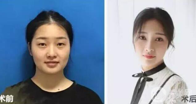 開眼角疼嗎？這幾種情況開眼角*果堪比換頭！